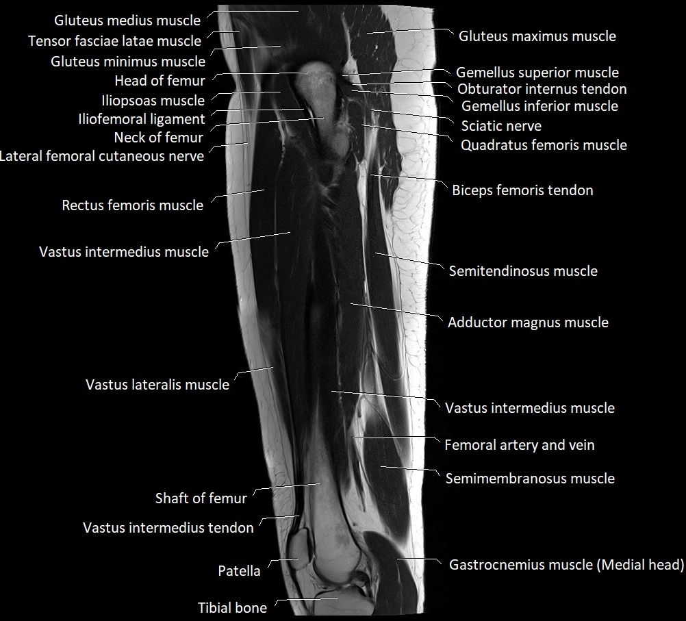 Thigh sagittal cross sectional anatomy MRI 3T image 10.webp